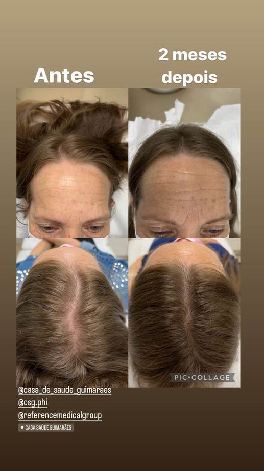 Protocolo Capilar — antes e depois (caso 1)