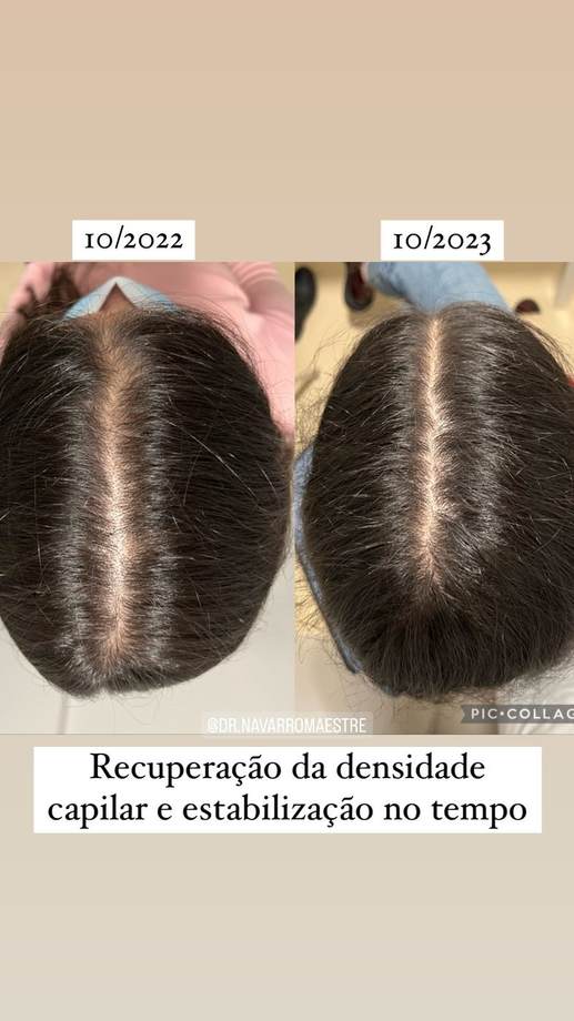 Protocolo Capilar — antes e depois (caso 2)