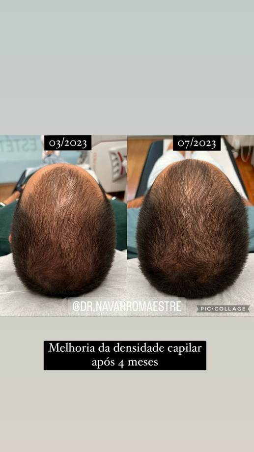 Protocolo Capilar — antes e depois (caso 3)