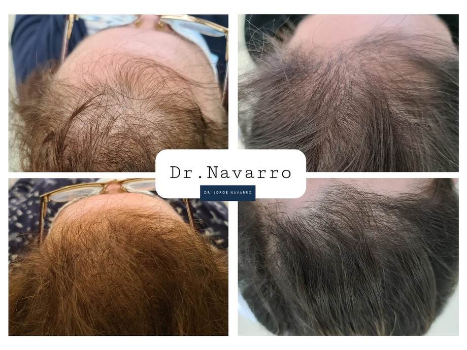 Protocolo Capilar — antes e depois (caso 4)