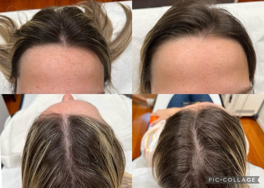 Protocolo Capilar — antes e depois (caso 5)