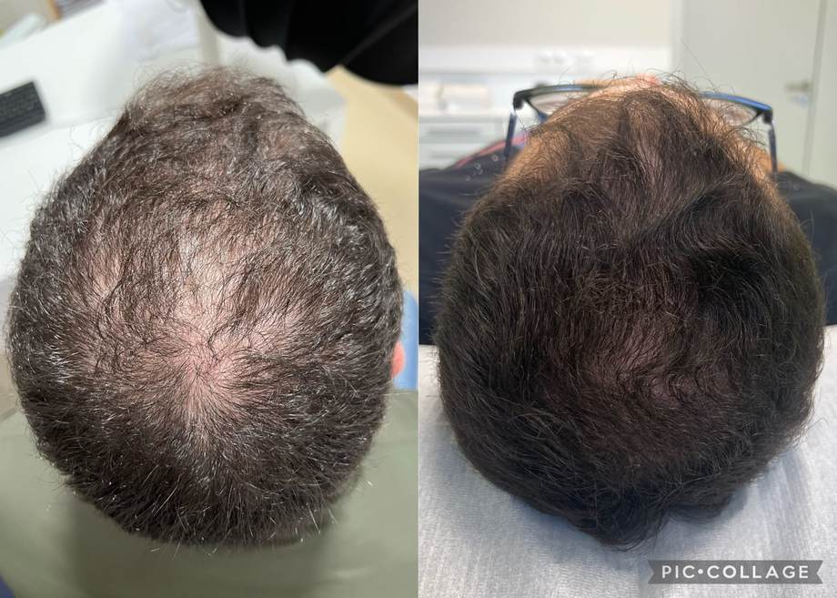 Protocolo Capilar — antes e depois (caso 6)
