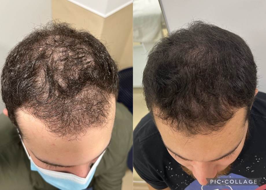 Protocolo Capilar — antes e depois (caso 7)