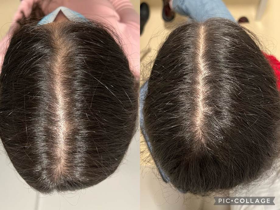 Protocolo Capilar — antes e depois (caso 8)
