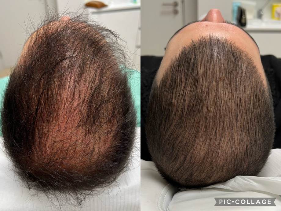 Protocolo Capilar — antes e depois (caso 9)