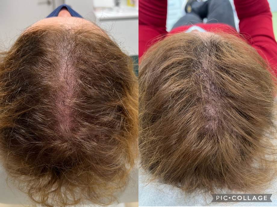 Protocolo Capilar — antes e depois (caso 10)