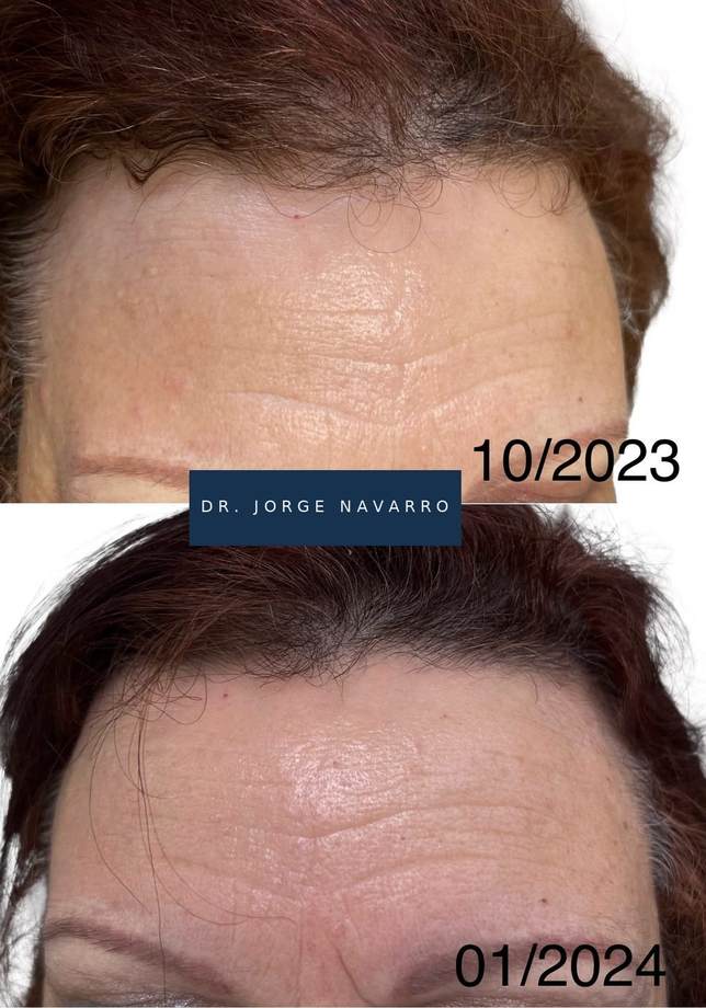 Protocolo Capilar — antes e depois (caso 11)