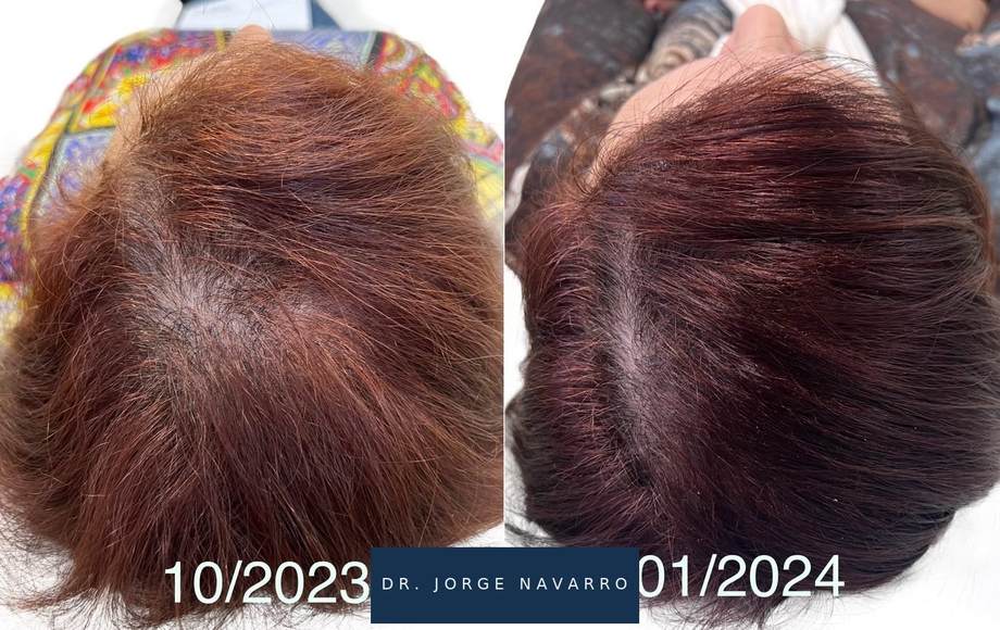Protocolo Capilar — antes e depois (caso 12)