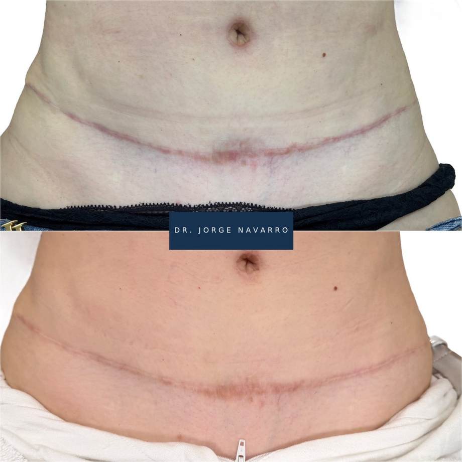 Tratamento de Cicatrizes — antes e depois (caso 1)