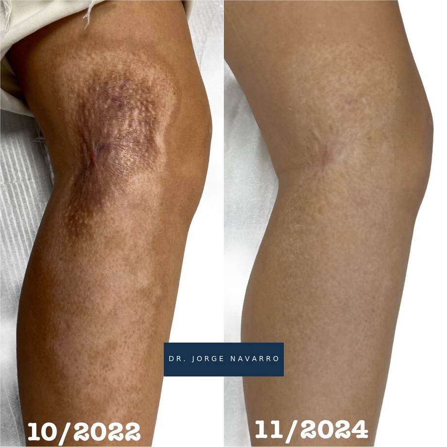 Tratamento de Cicatrizes — antes e depois (caso 2)