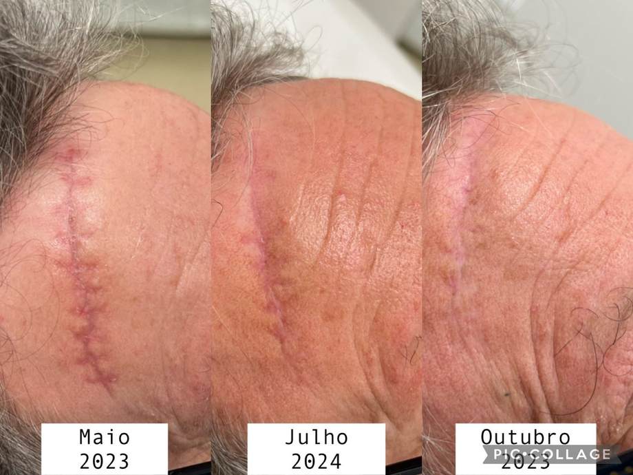 Tratamento de Cicatrizes — antes e depois (caso 3)