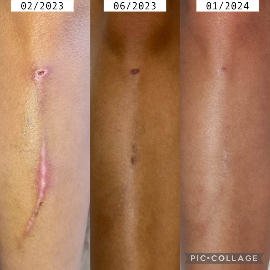 Tratamento de Cicatrizes — antes e depois (caso 7)