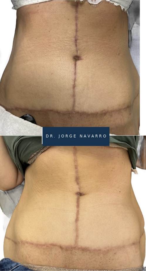 Tratamento de Cicatrizes — antes e depois (caso 8)