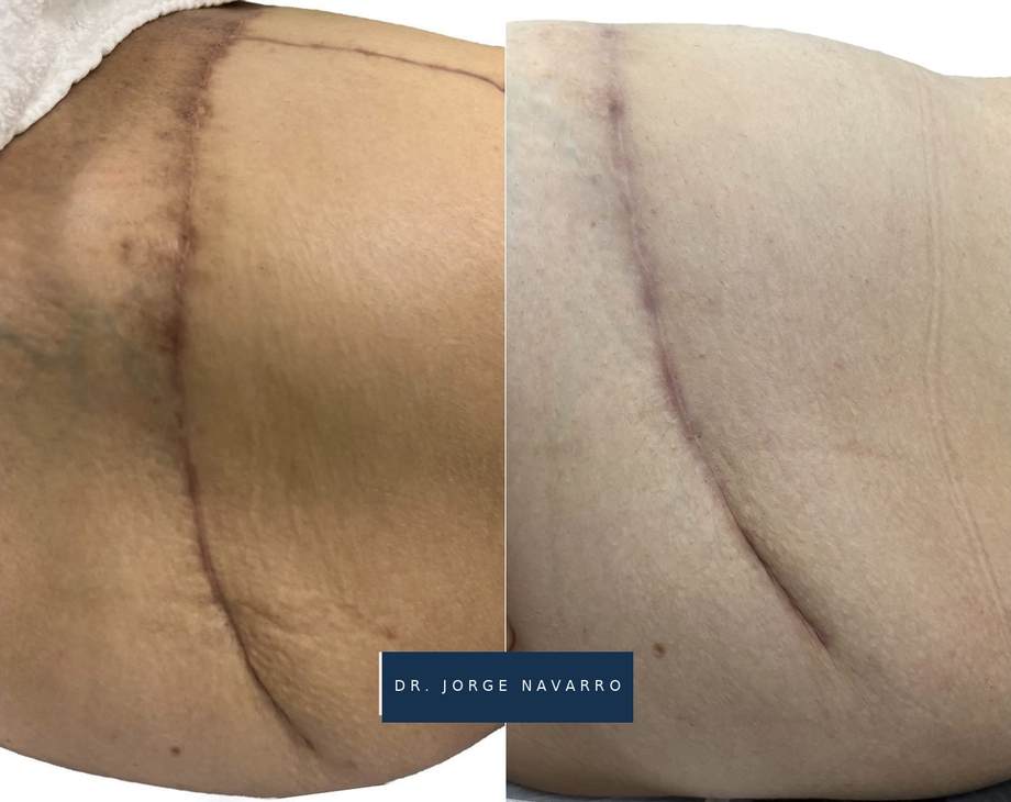Tratamento de Cicatrizes — antes e depois (caso 9)