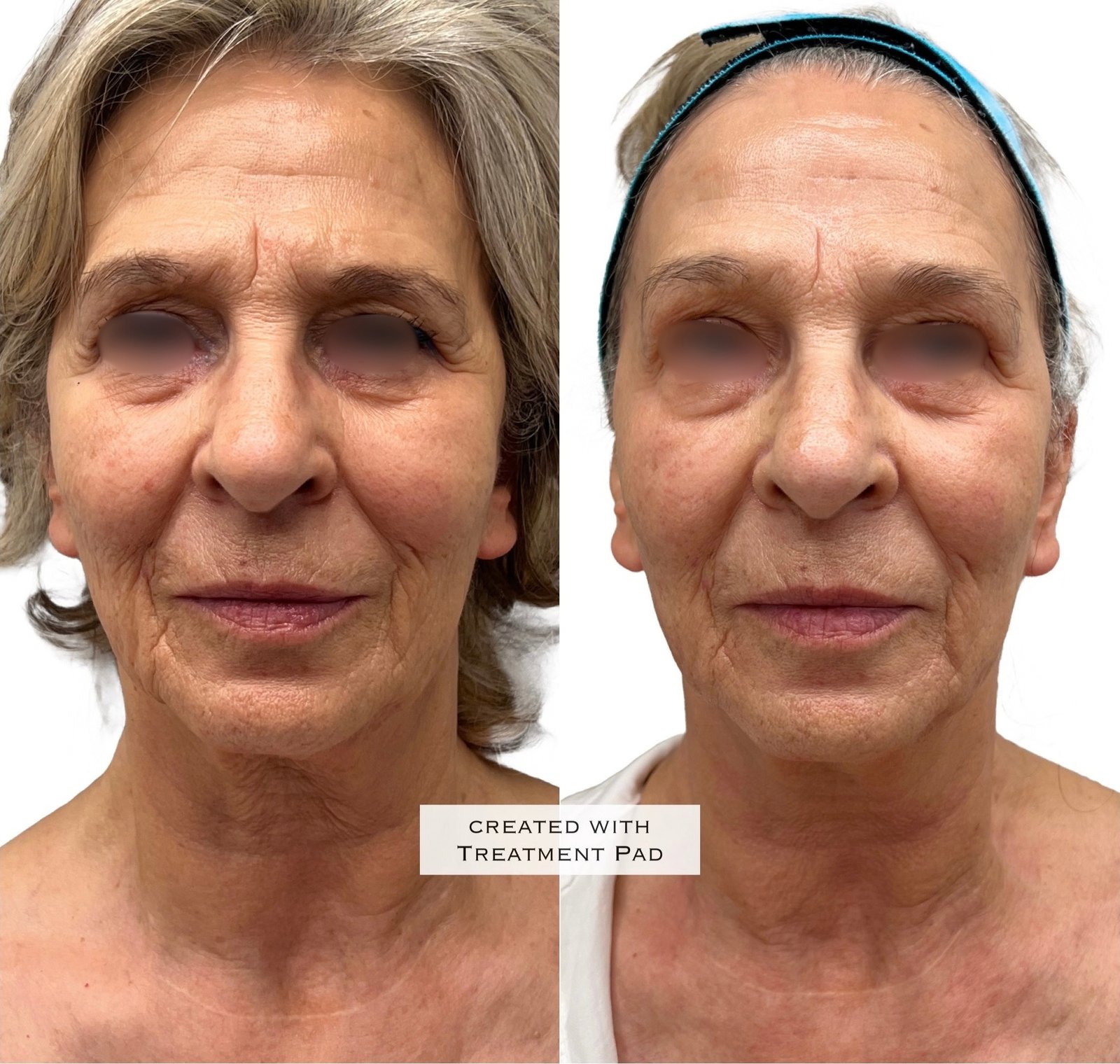 EXION Facial — antes e depois (caso 1)