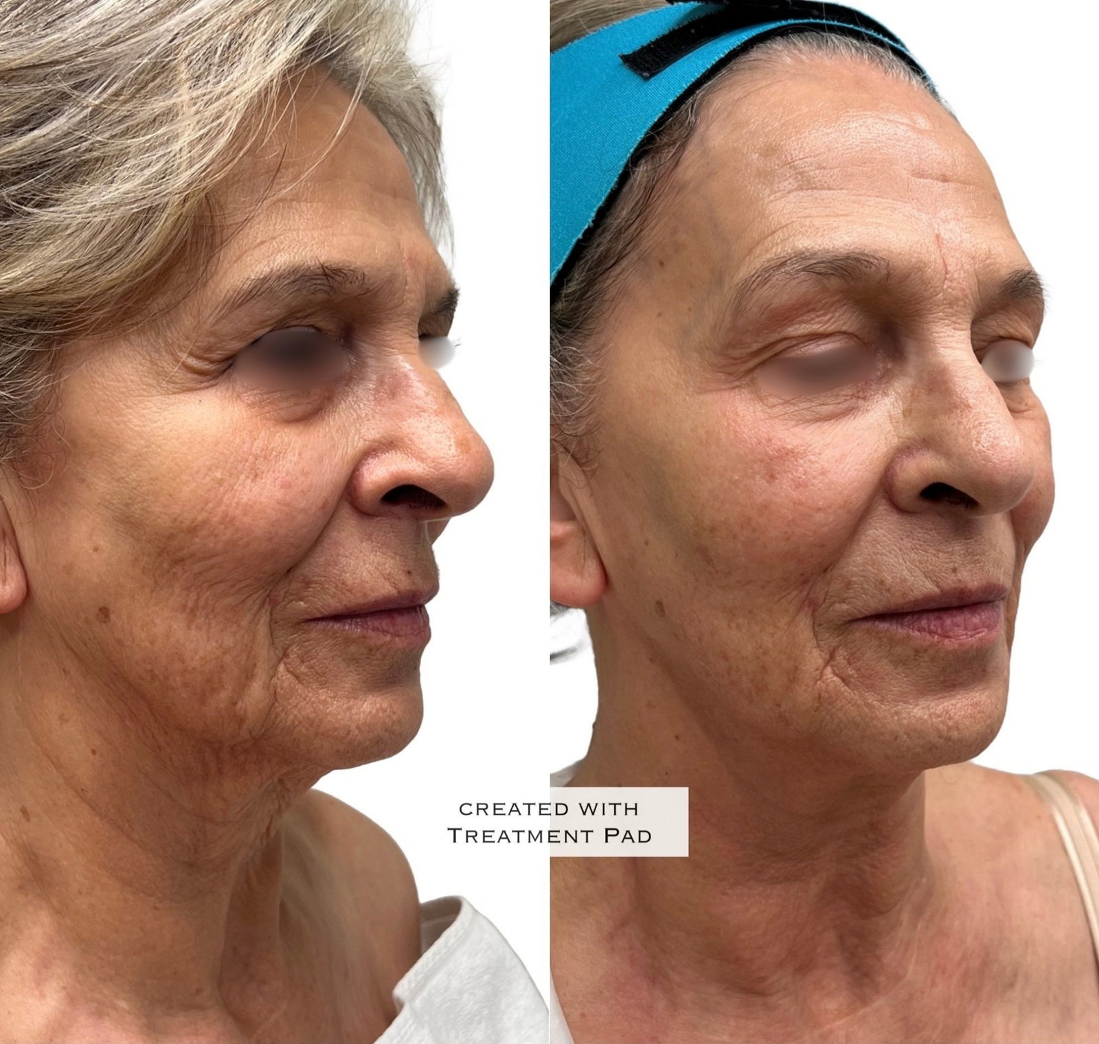 EXION Facial — antes e depois (caso 2)