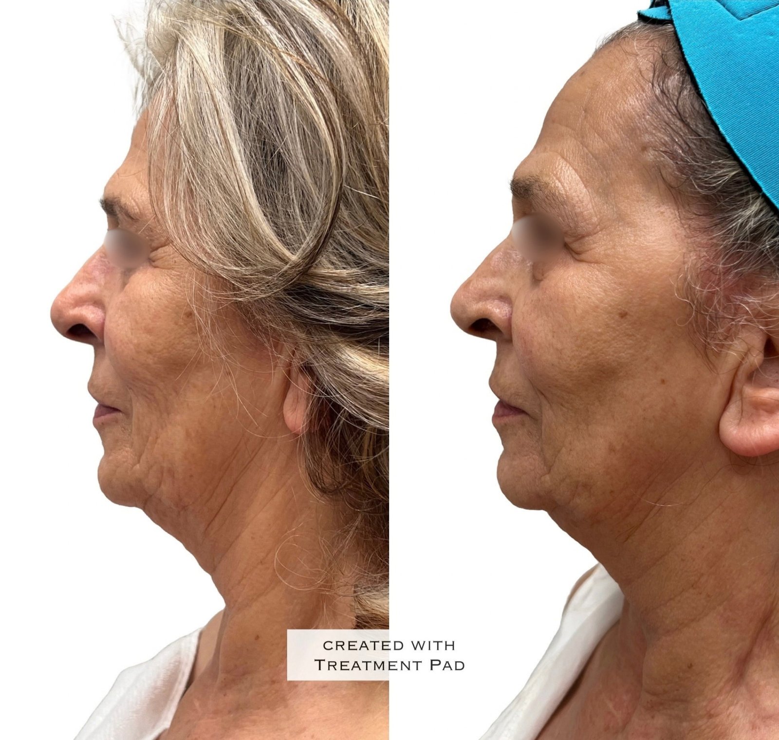 EXION Facial — antes e depois (caso 3)