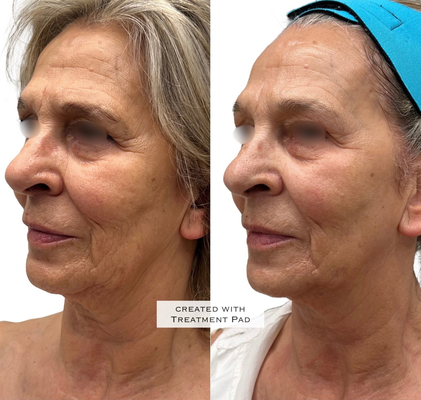 Resultados de EXION Facial