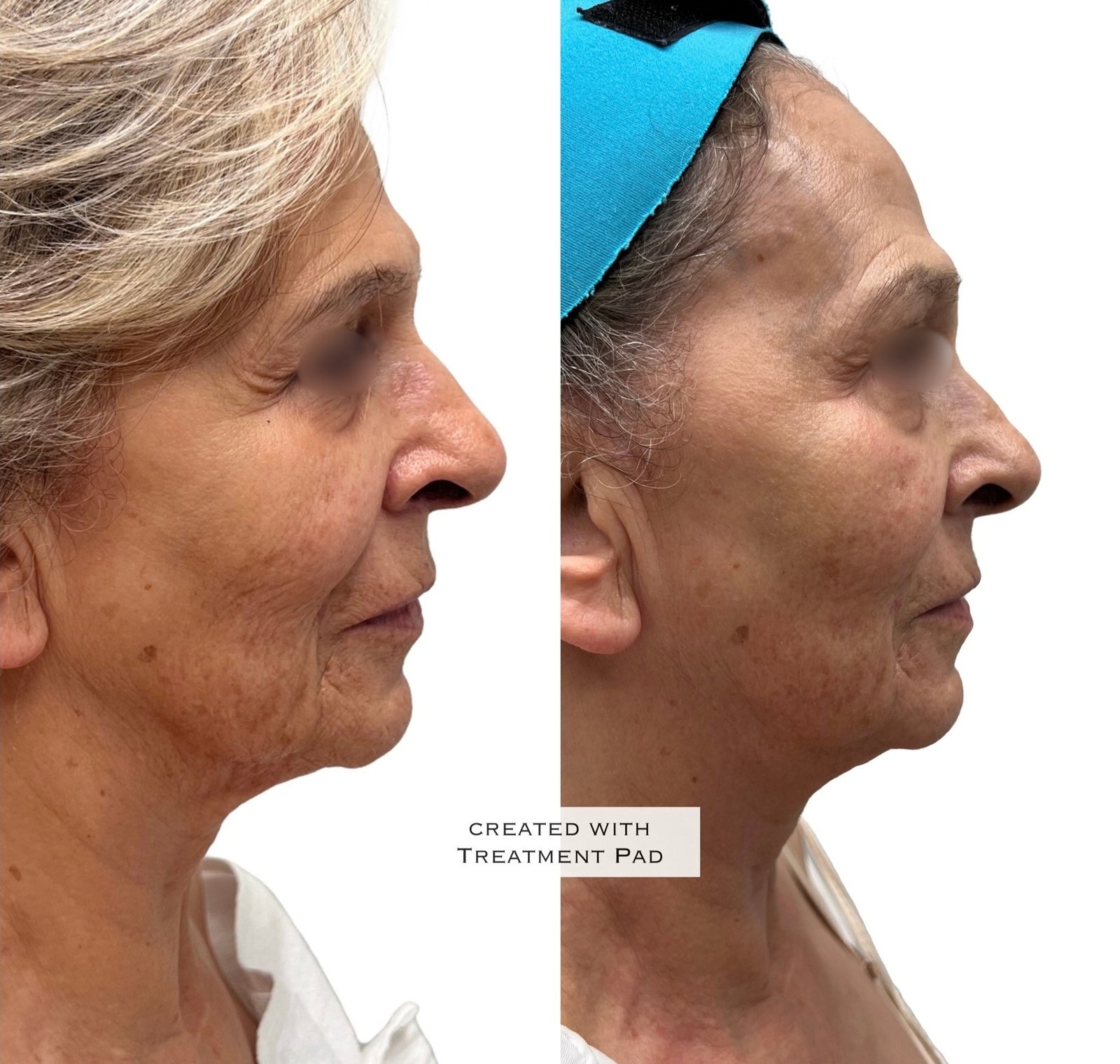 EXION Facial — antes e depois (caso 5)
