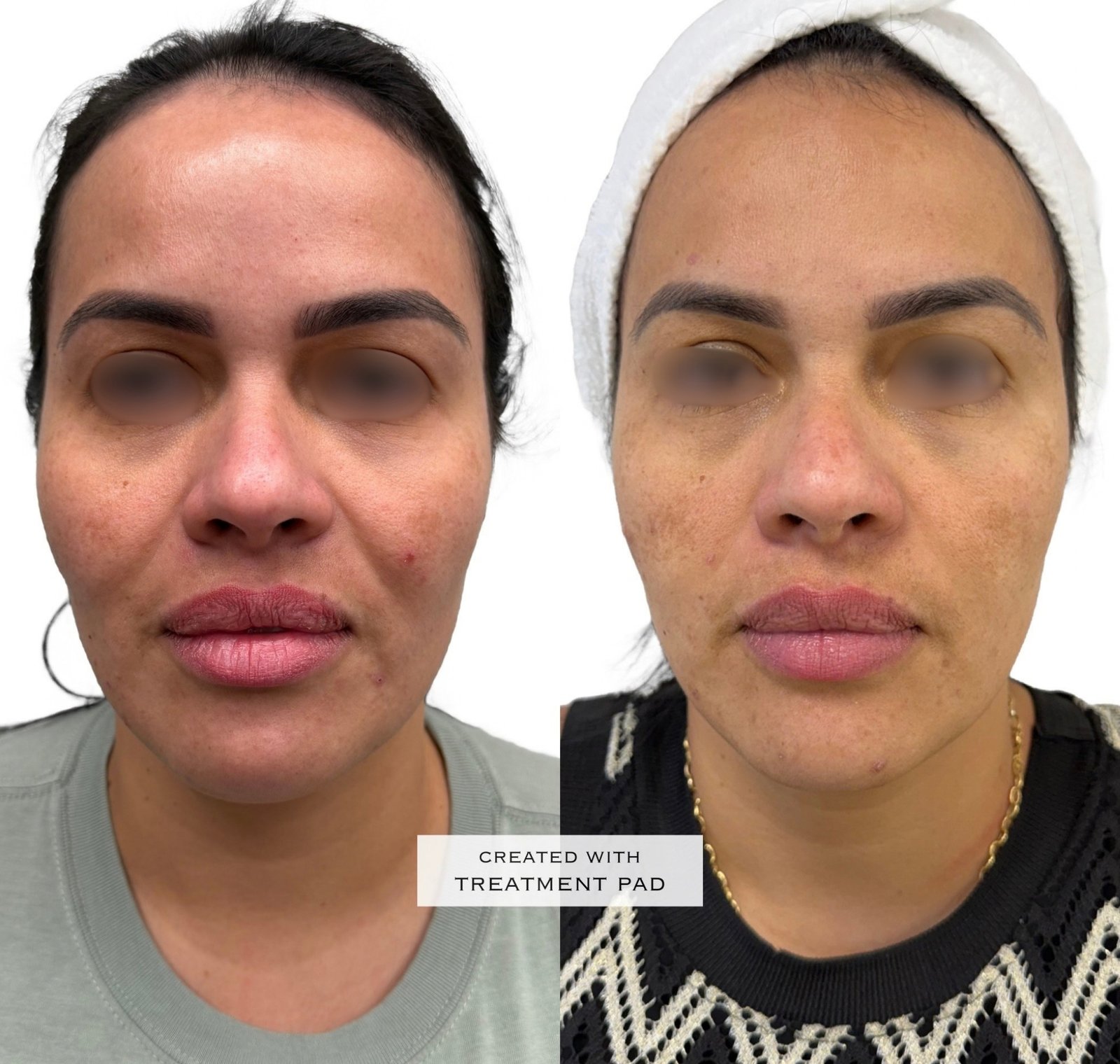EXION Facial — antes e depois (caso 6)