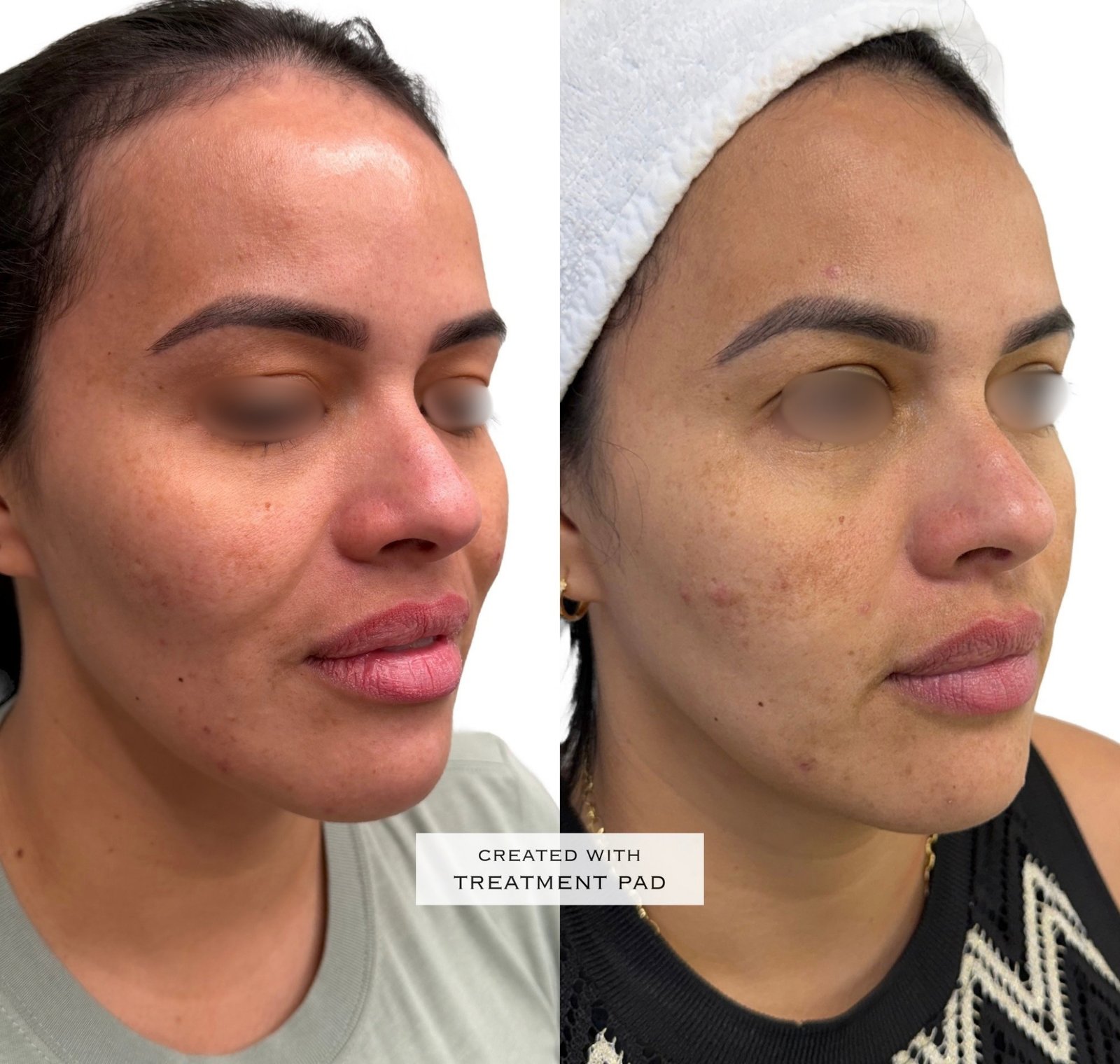 EXION Facial — antes e depois (caso 7)