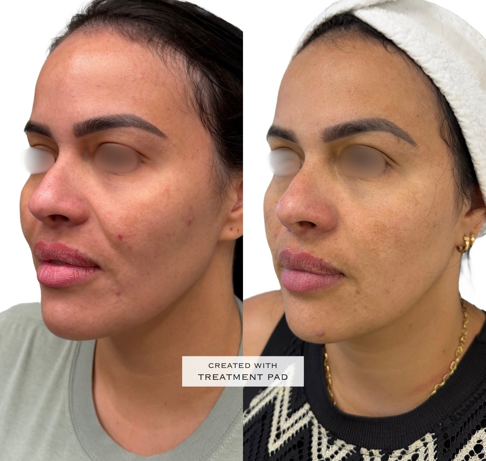 EXION Facial — antes e depois (caso 8)