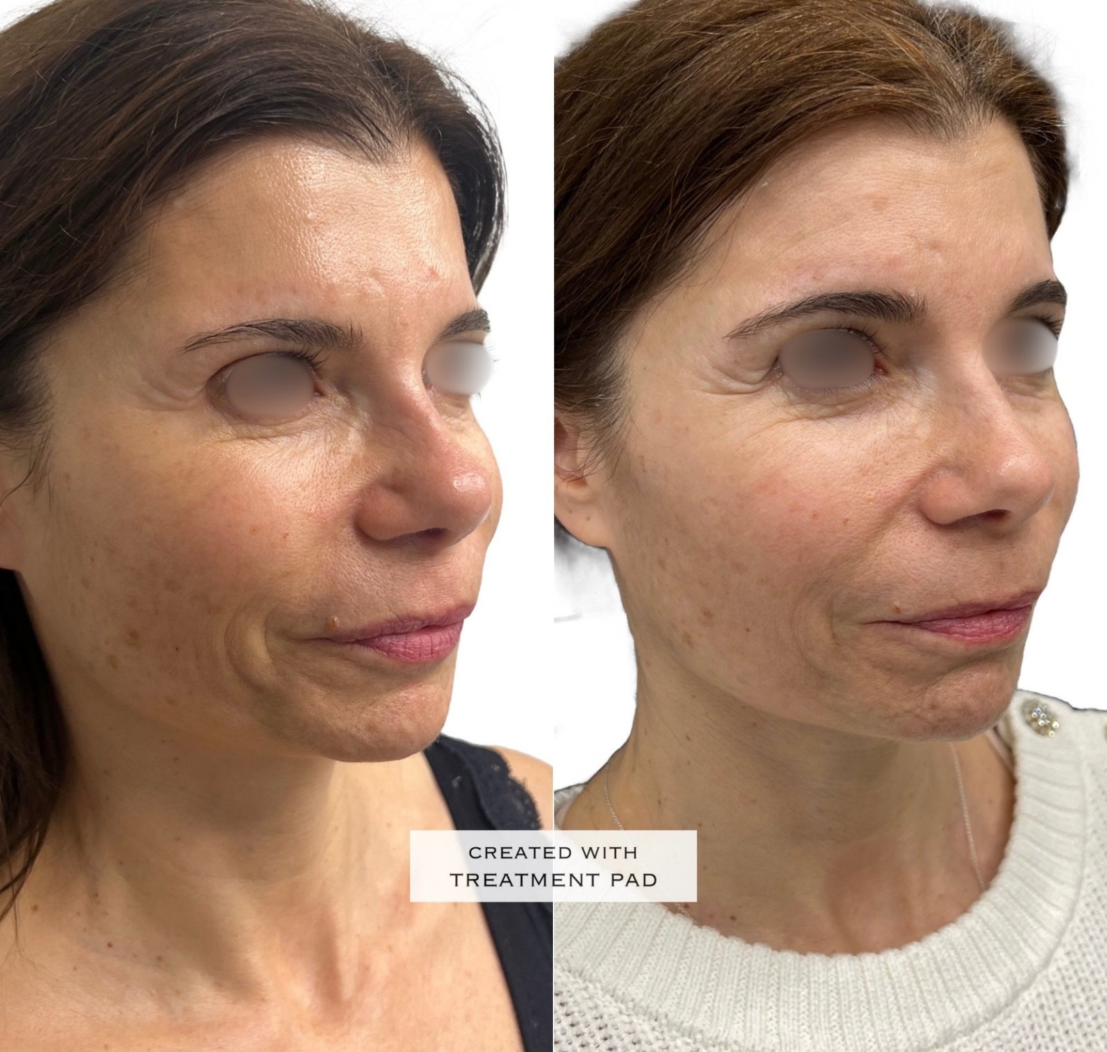 EXION Facial — antes e depois (caso 10)