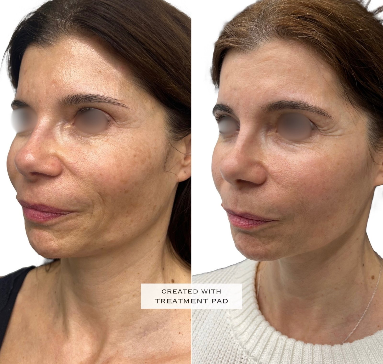 EXION Facial — antes e depois (caso 11)