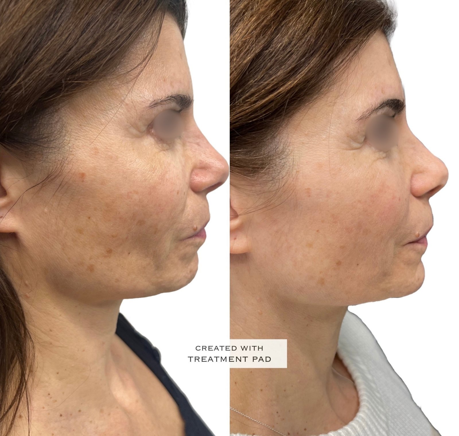 EXION Facial — antes e depois (caso 12)
