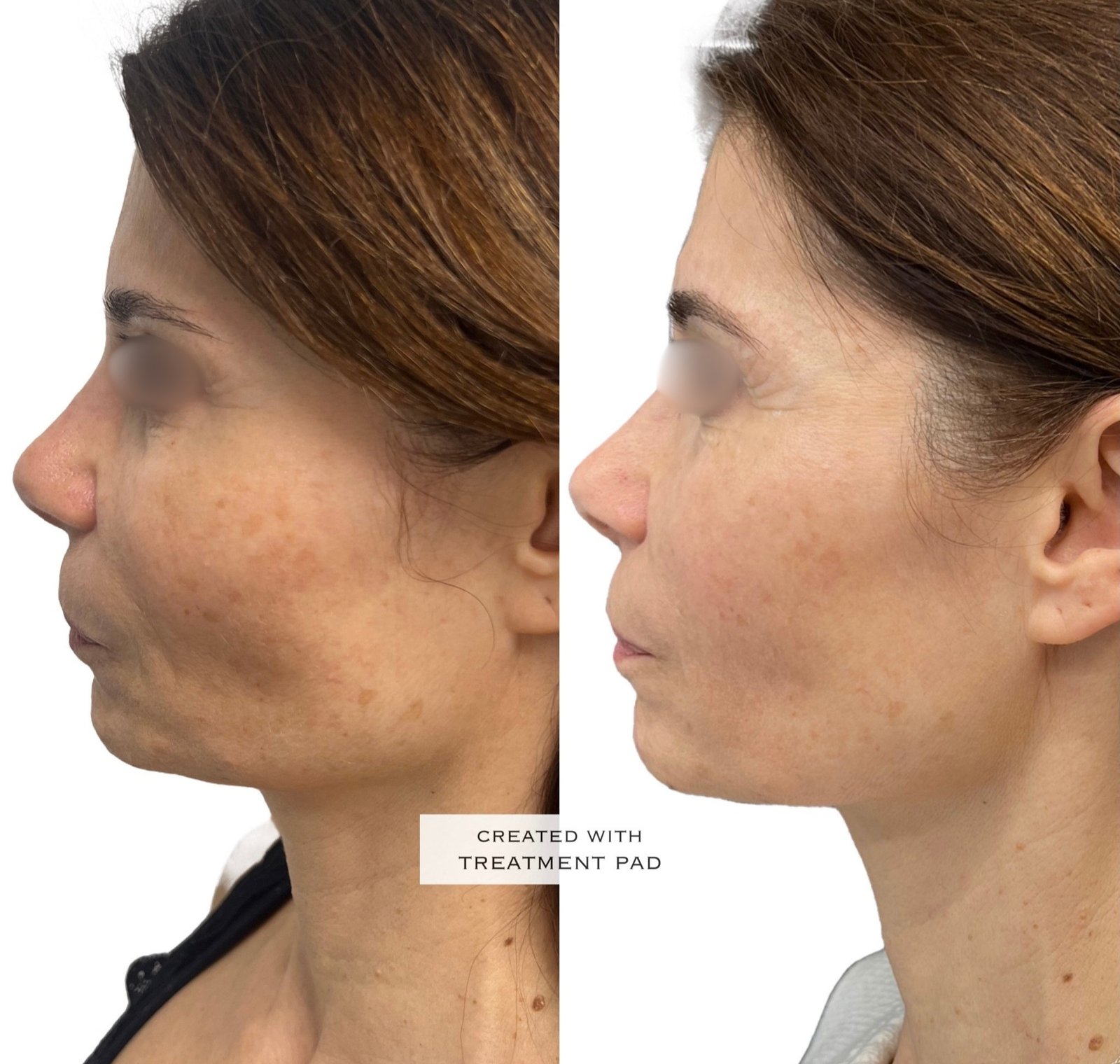EXION Facial — antes e depois (caso 13)