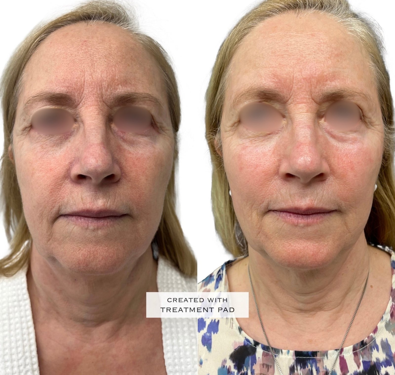 EXION Facial — antes e depois (caso 14)