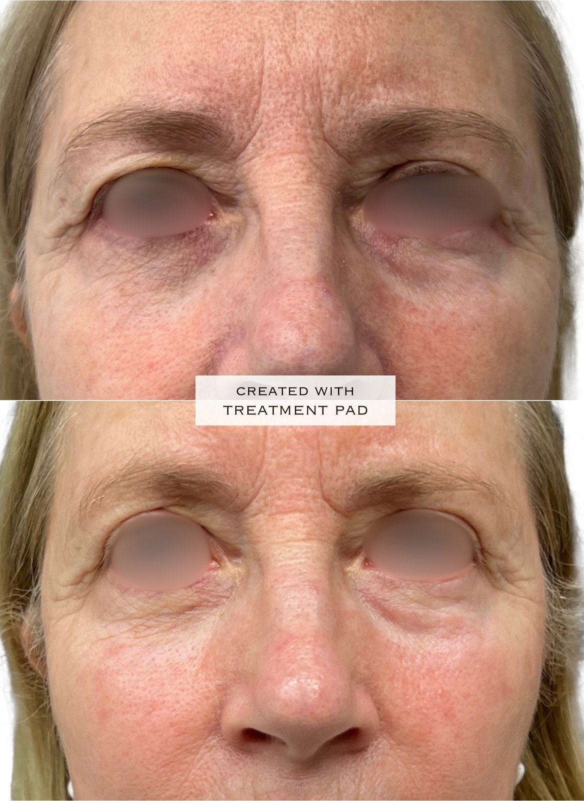 EXION Facial — antes e depois (caso 15)