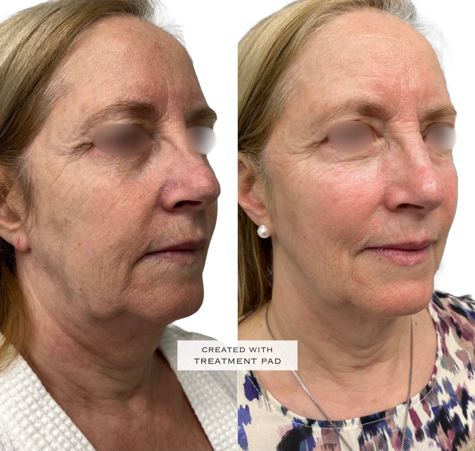 EXION Facial — antes e depois (caso 16)