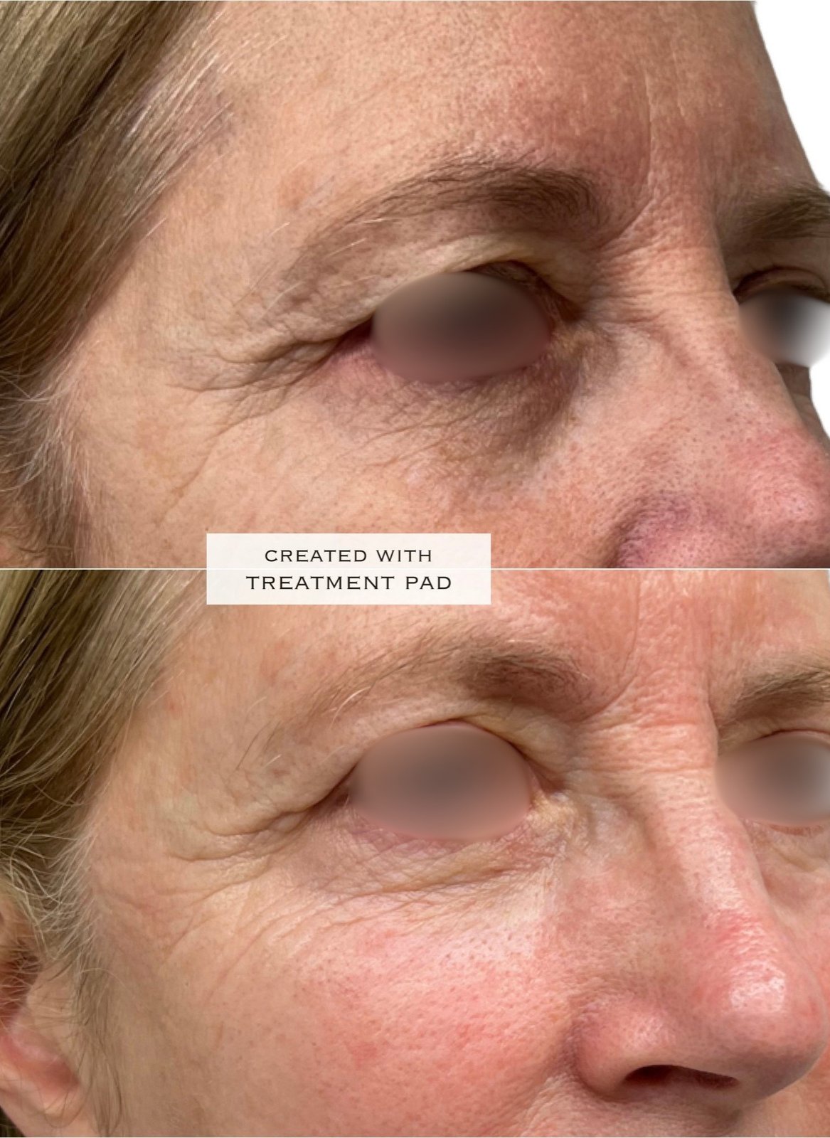EXION Facial — antes e depois (caso 17)