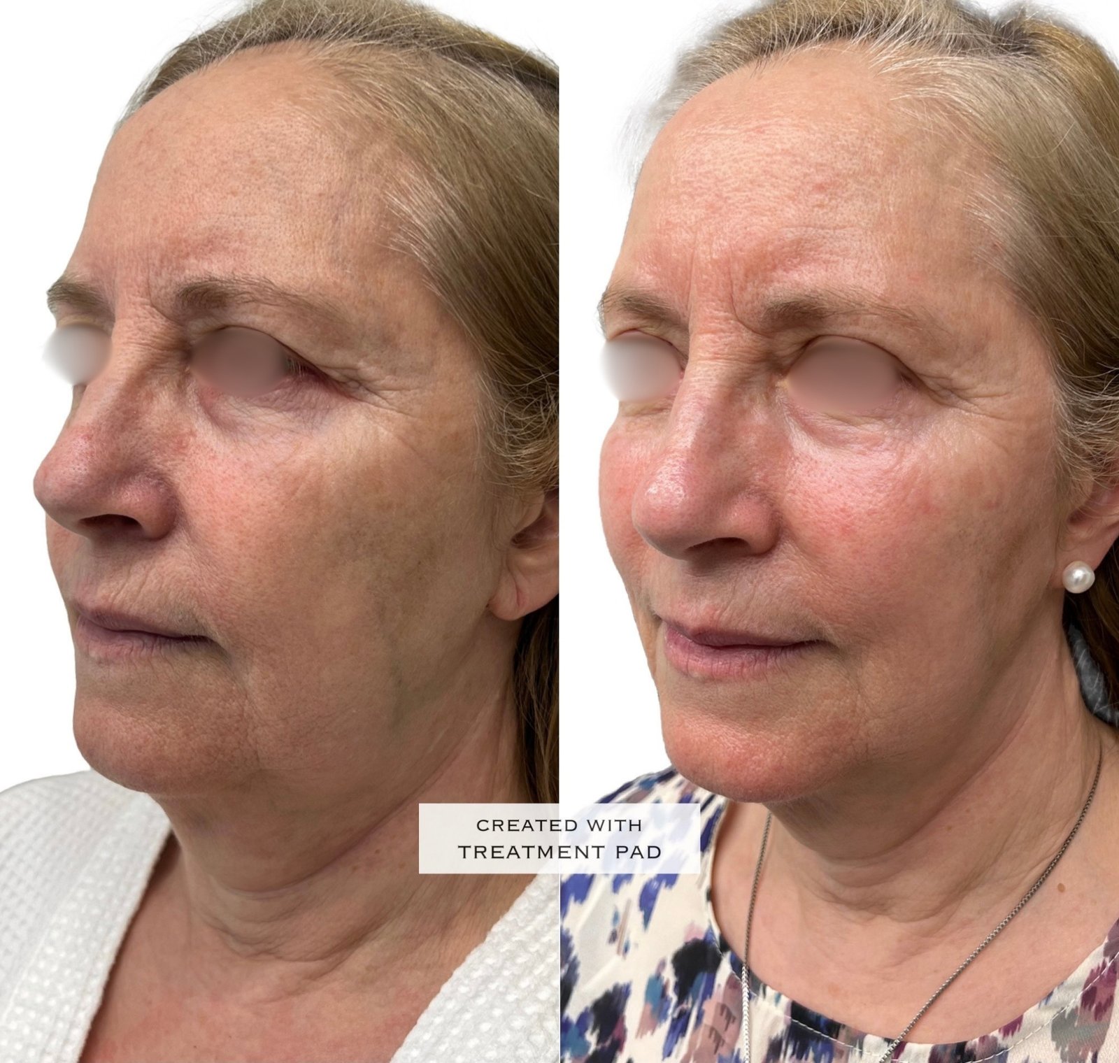 EXION Facial — antes e depois (caso 18)