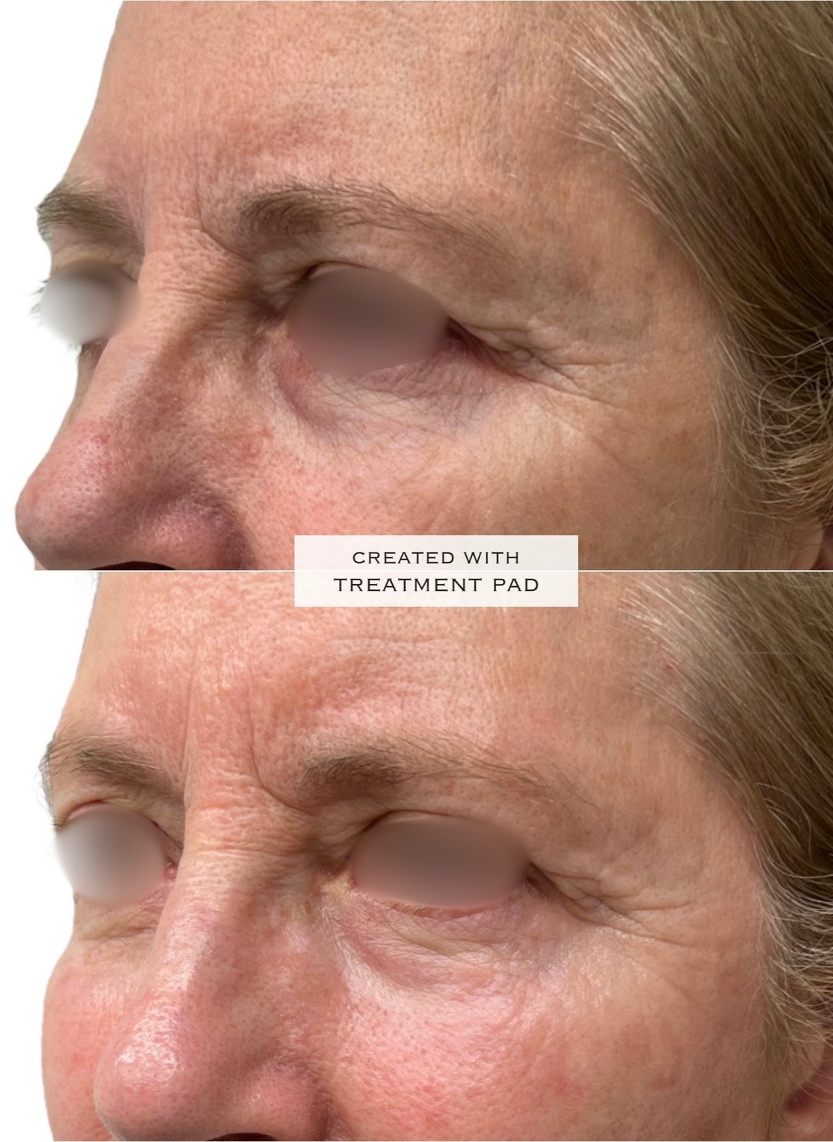 EXION Facial — antes e depois (caso 19)