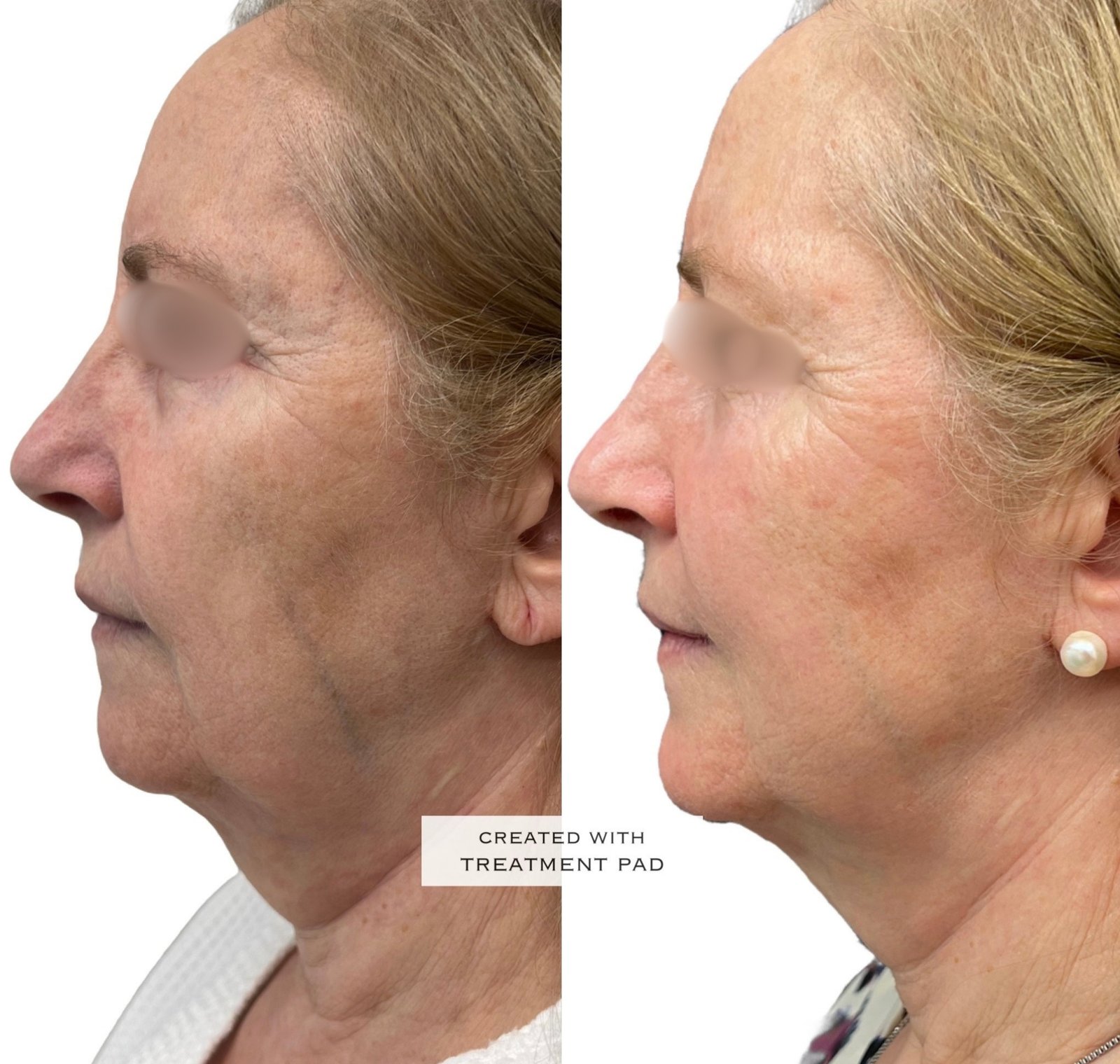 EXION Facial — antes e depois (caso 20)