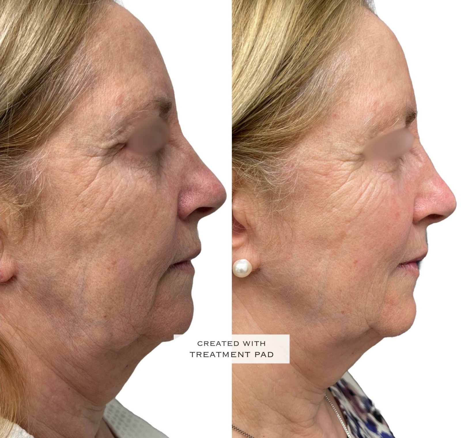 EXION Facial — antes e depois (caso 21)