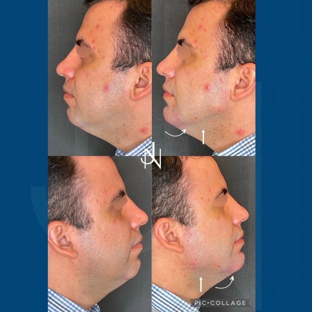 Ácido Hialurónico · Harmonização Facial — antes e depois (caso 1)