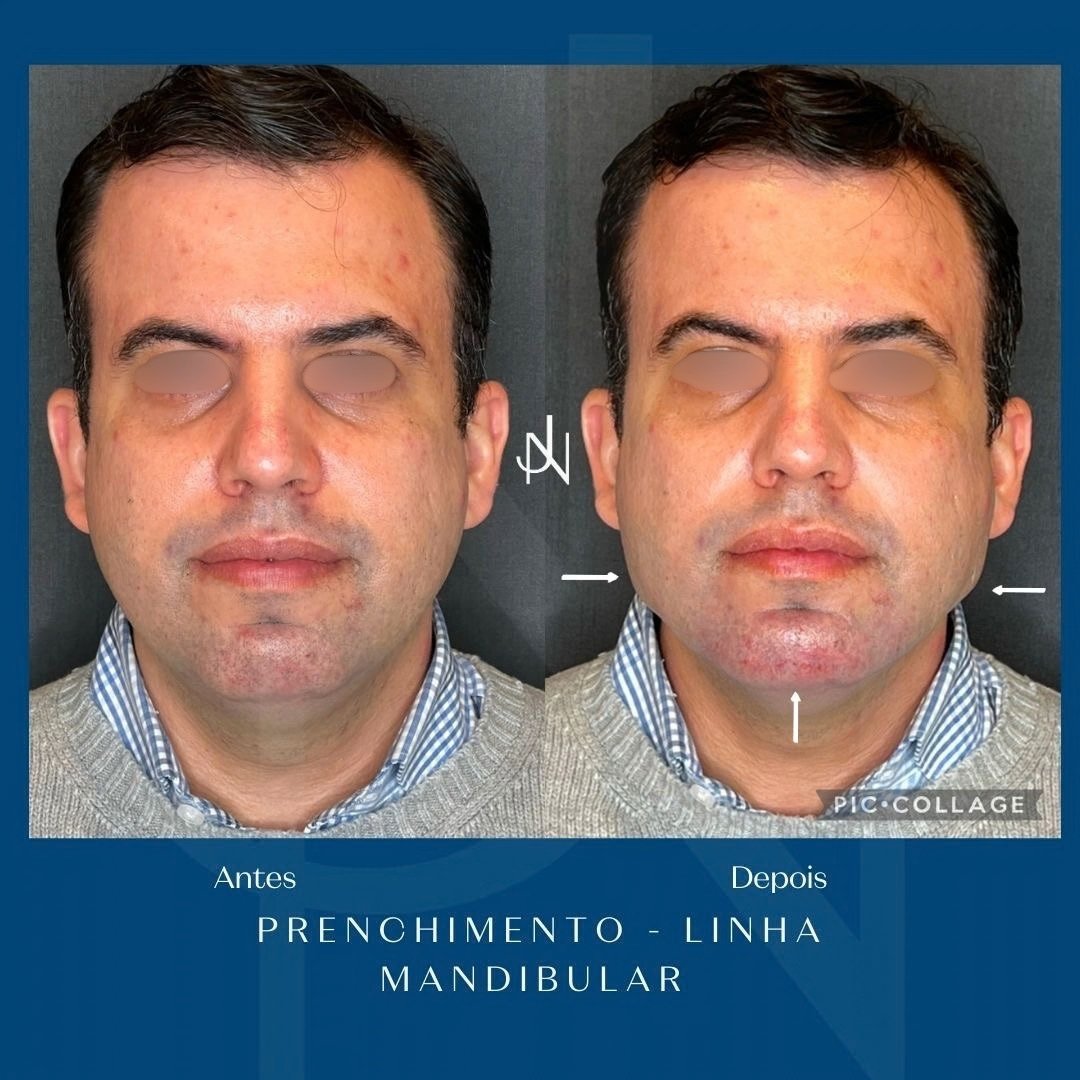 Ácido Hialurónico · Harmonização Facial — antes e depois (caso 2)