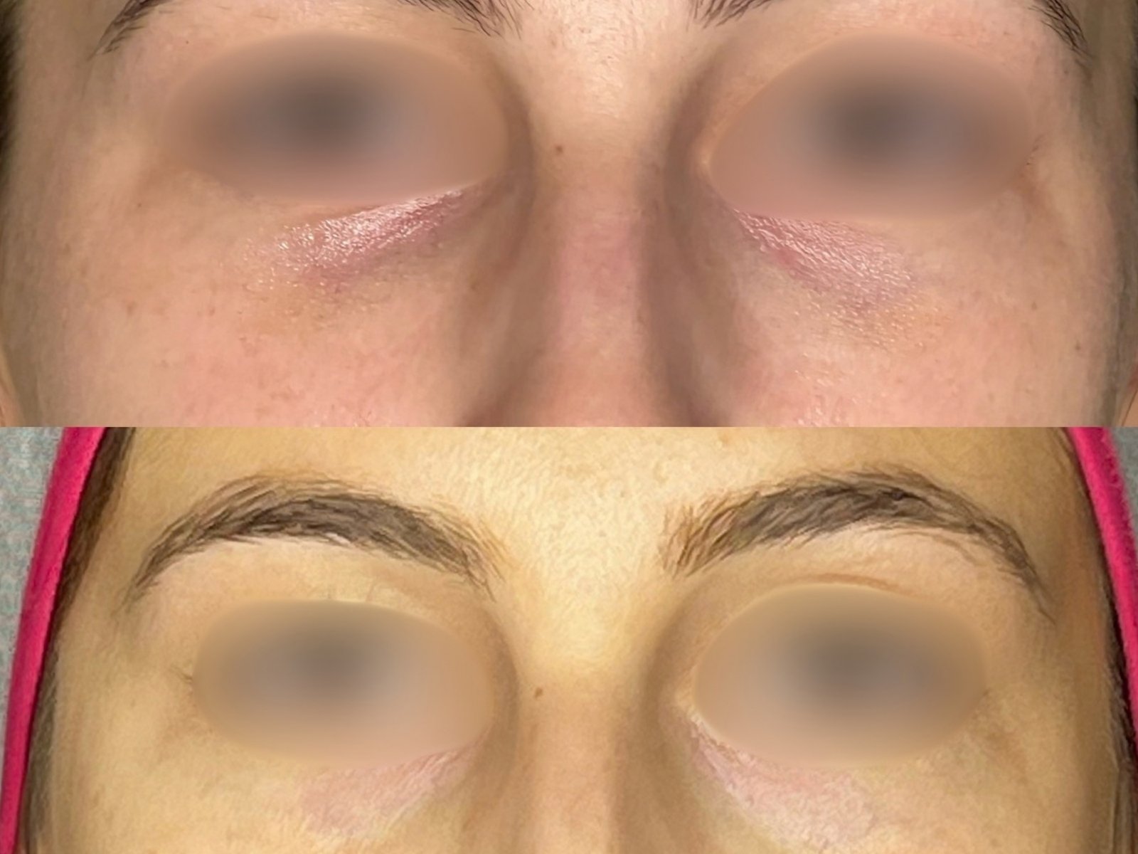 Ácido Hialurónico · Harmonização Facial — antes e depois (caso 3)