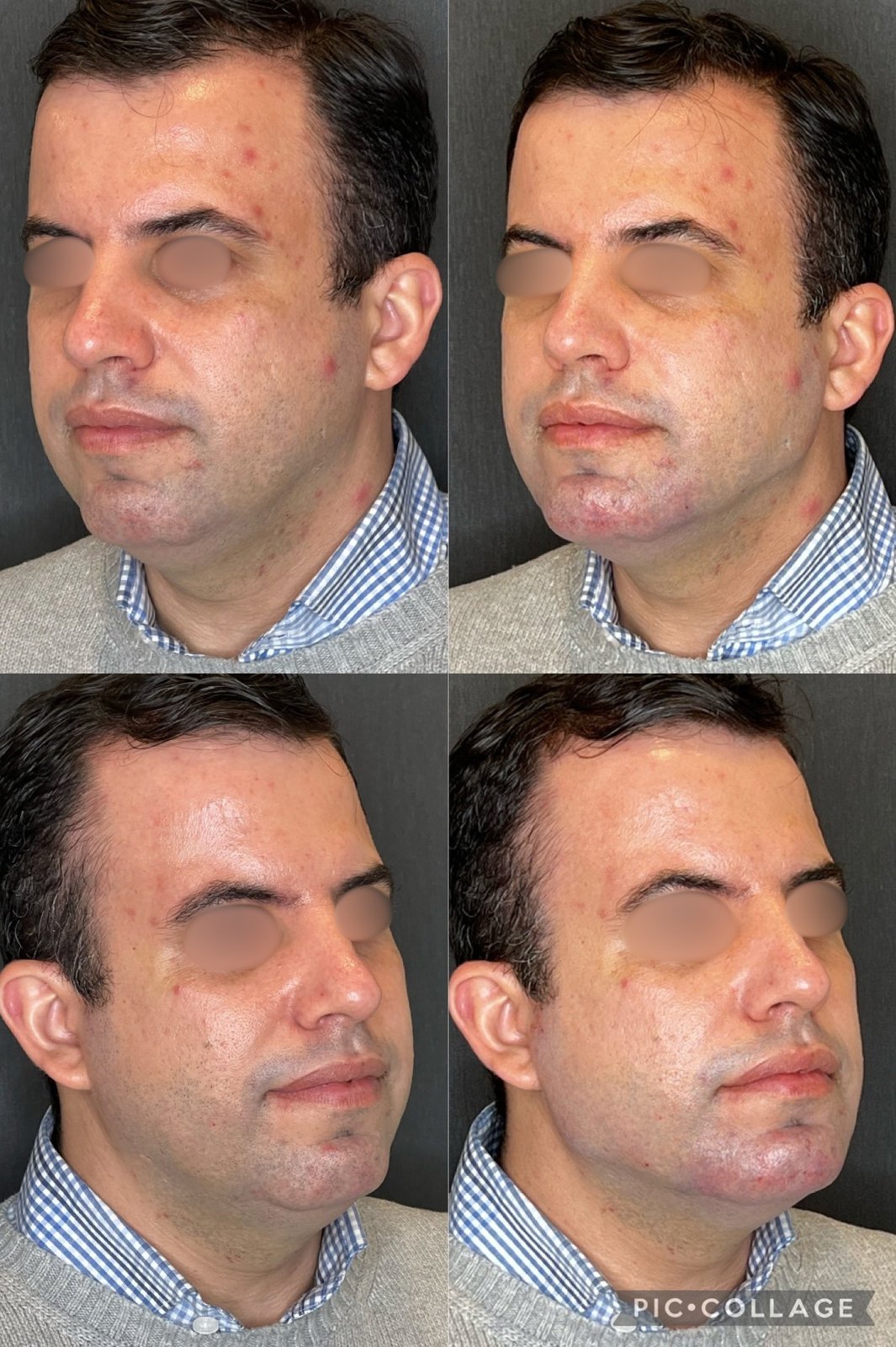 Ácido Hialurónico · Harmonização Facial — antes e depois (caso 4)