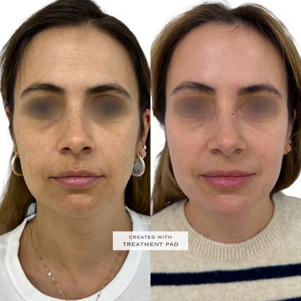 HIFU — antes e depois (caso 2)
