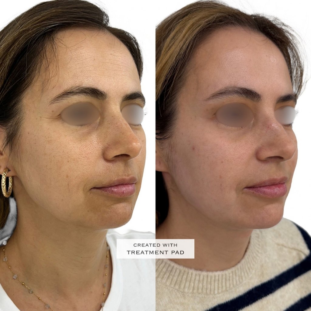 HIFU — antes e depois (caso 3)
