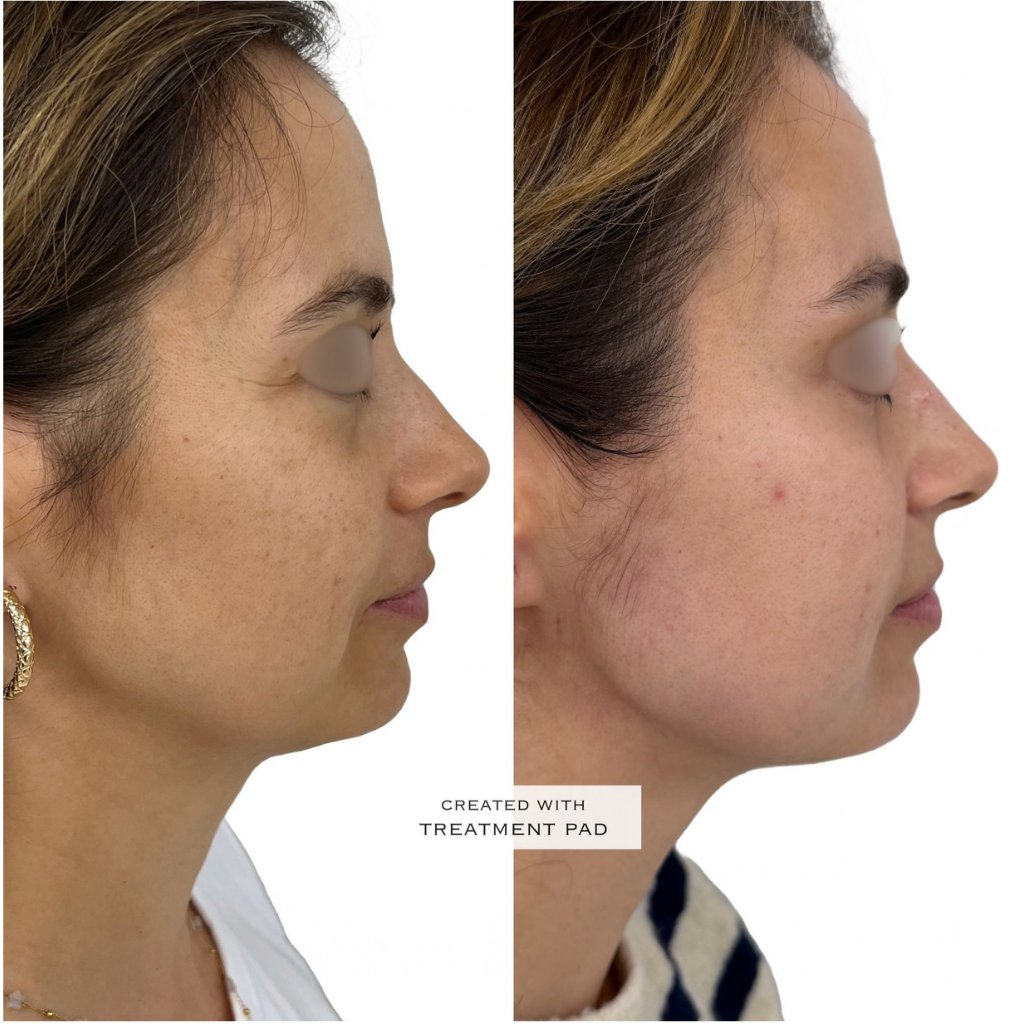 HIFU — antes e depois (caso 4)