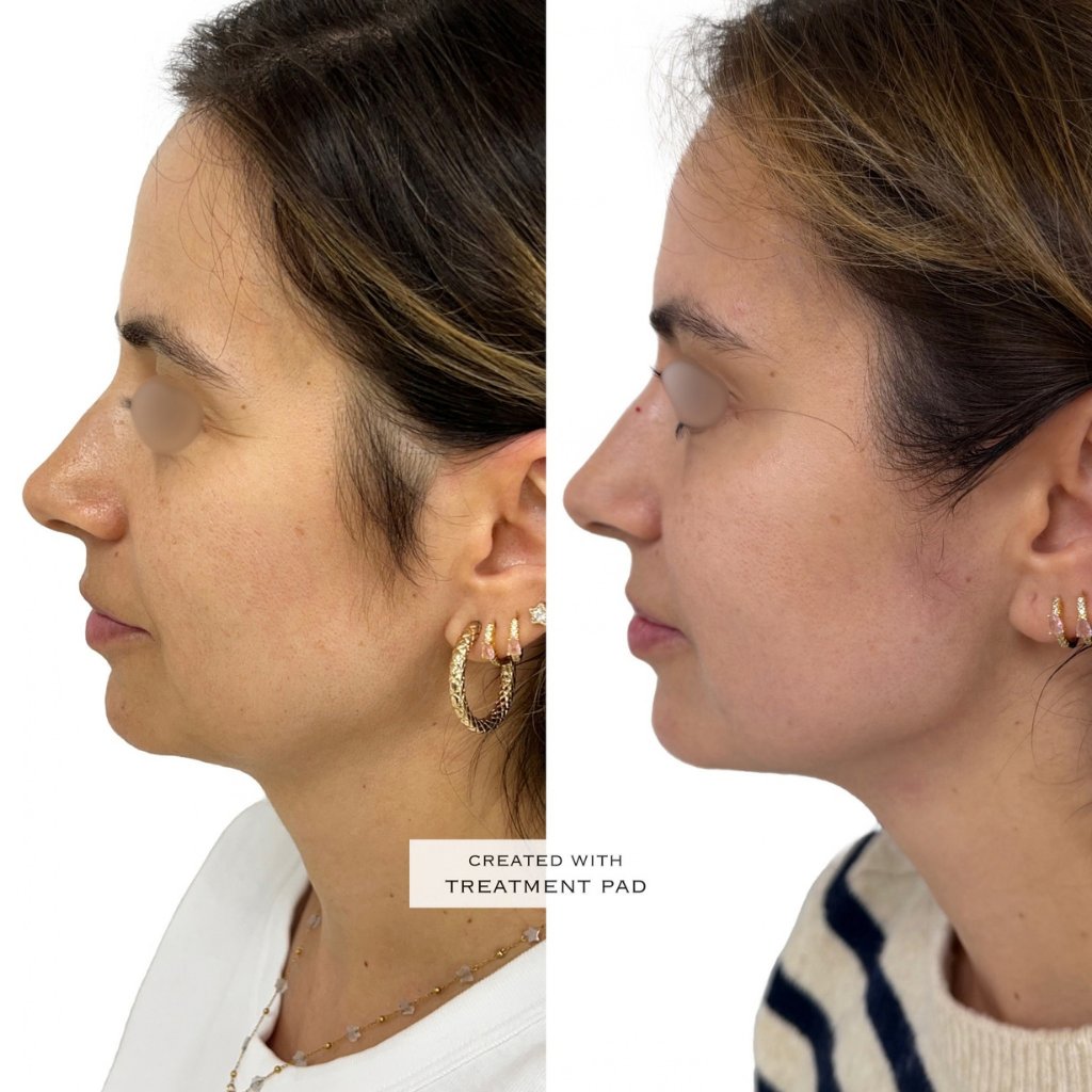 HIFU — antes e depois (caso 5)