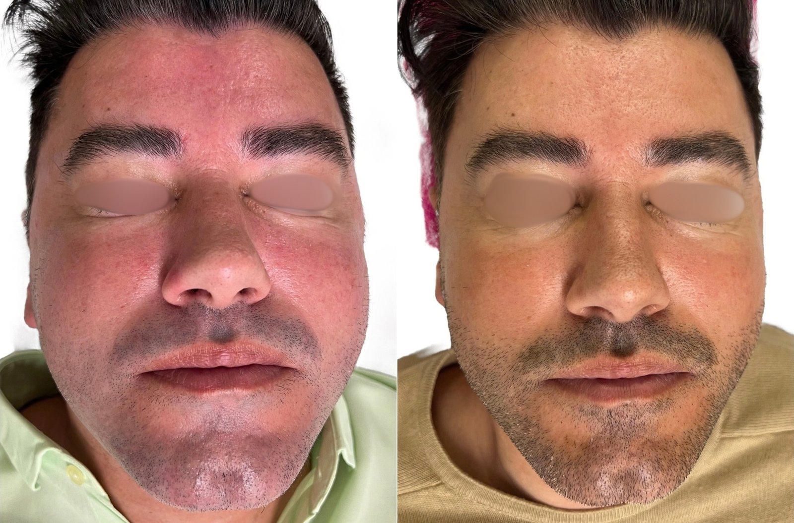 HIFU — antes e depois (caso 6)