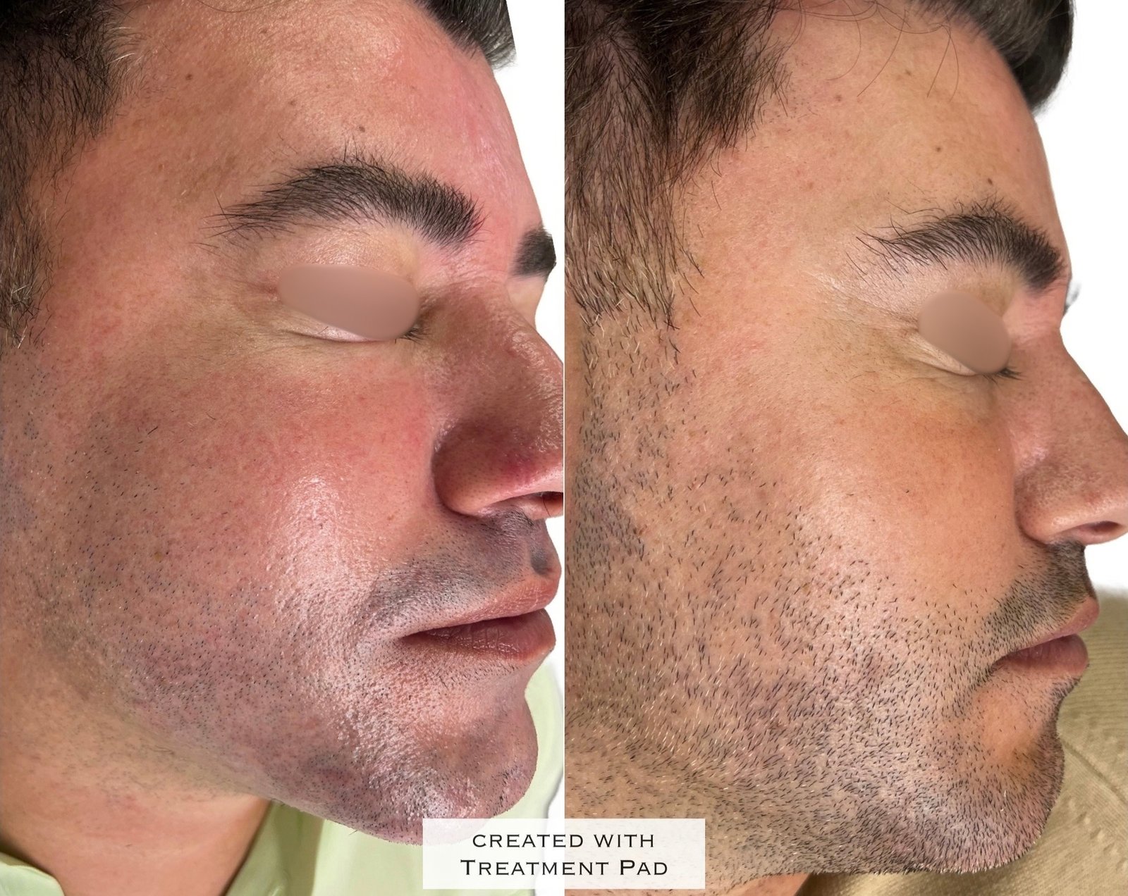 HIFU — antes e depois (caso 7)