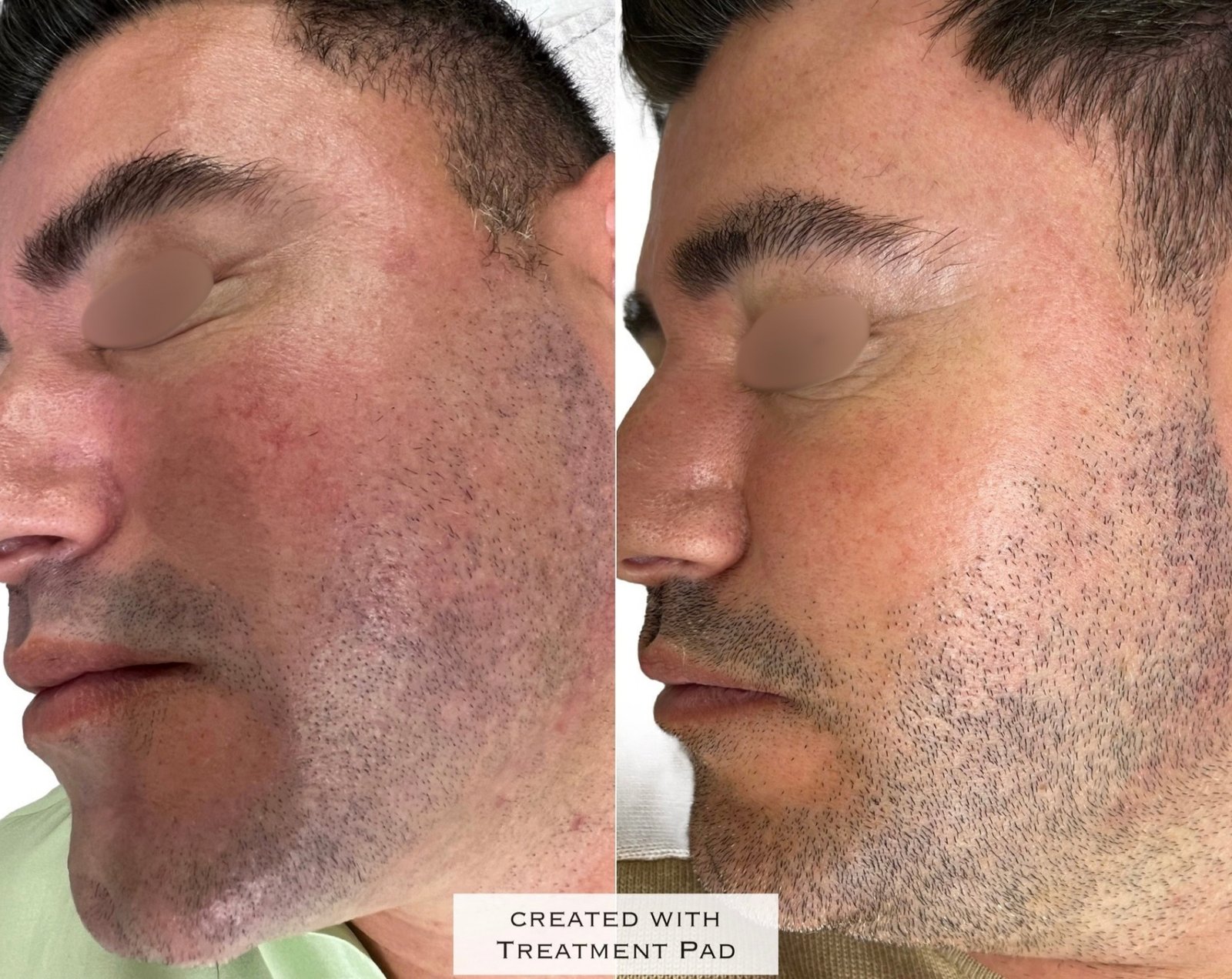 HIFU — antes e depois (caso 8)