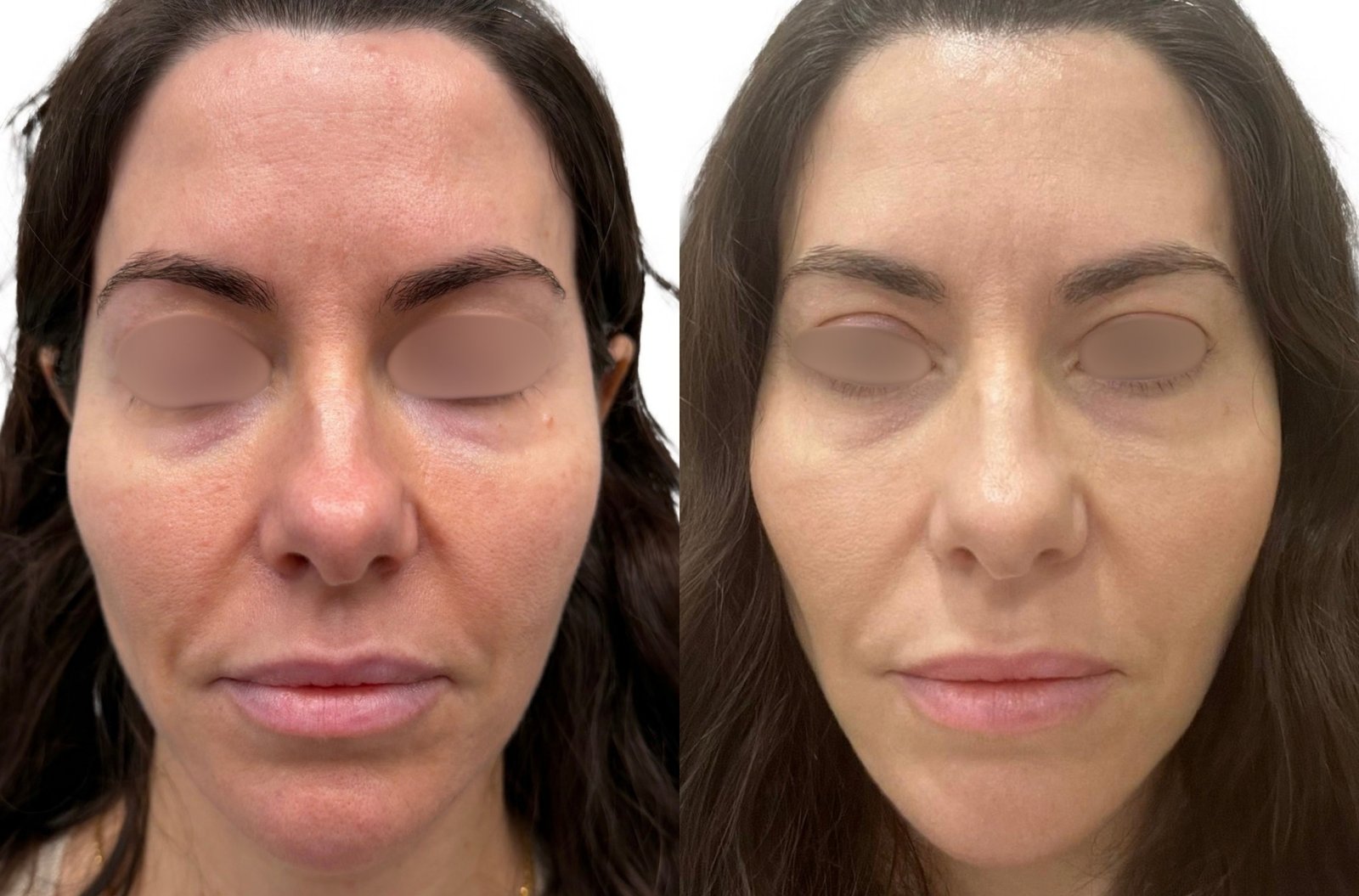 HIFU — antes e depois (caso 9)